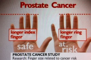 Prostate cancer is now predicted through ring-finger’s length Finger-and-Prostate-Cancer