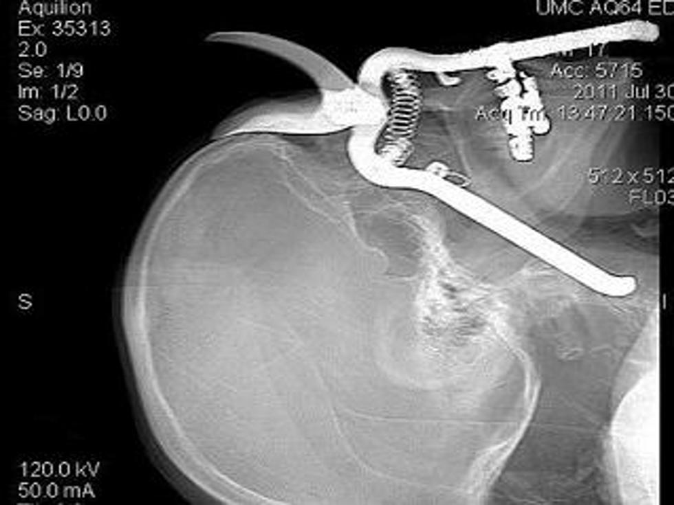 Man Impaled Through Eye by Pruning Shears, Retains Sight [PICTURE, VIDEO]