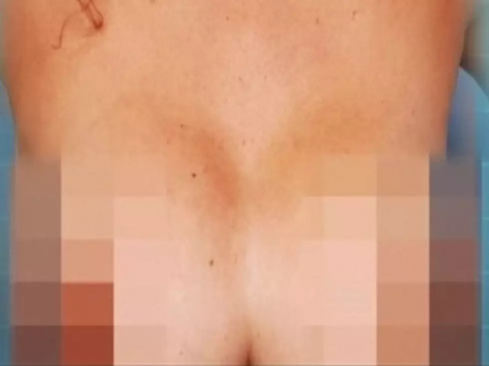 Botched Plastic Surgery Leaves Woman With &#8216;Uniboob&#8217;