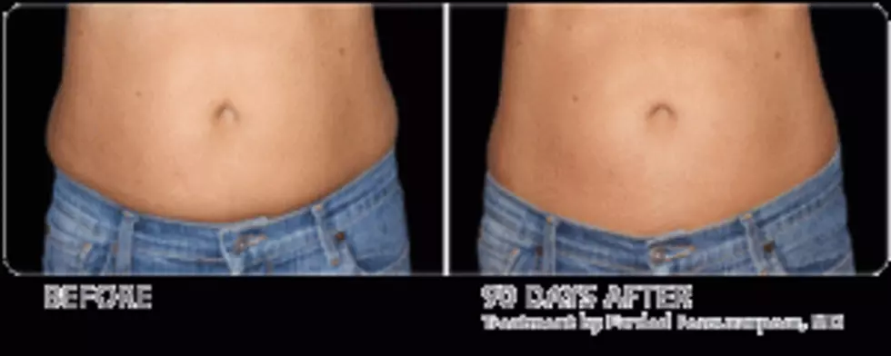 Non-Invasive CoolSculpting Procedure Is Turning Heads